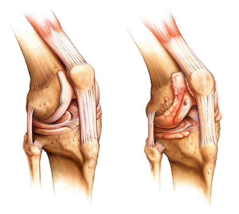 Articolazione sana (sinistra) e articolare artritica (destra)