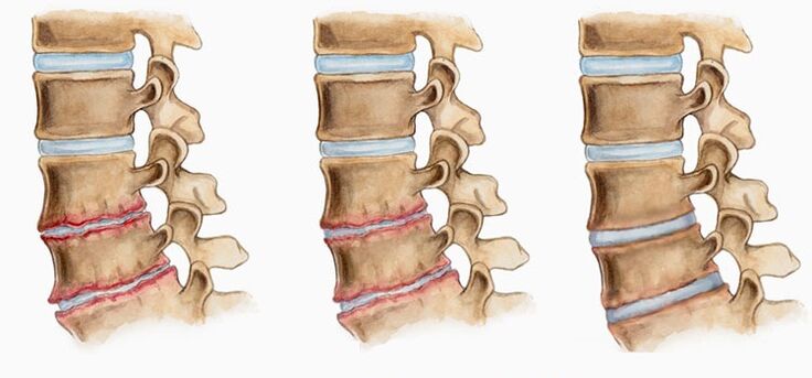 La deformazione dei dischi intervertebrali nell'osteocondrosi può causare mal di schiena