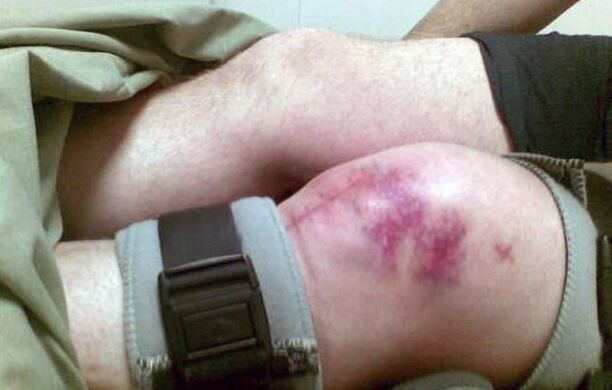 Le cause dell'osteoartrite dell'articolazione del ginocchio