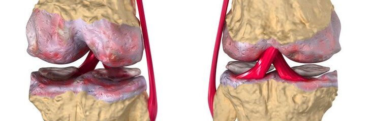 Articolazione sana e osteoartrite dell'articolazione del ginocchio