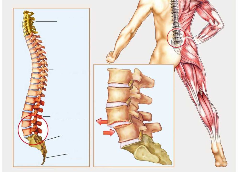 colonna vertebrale sana e malata