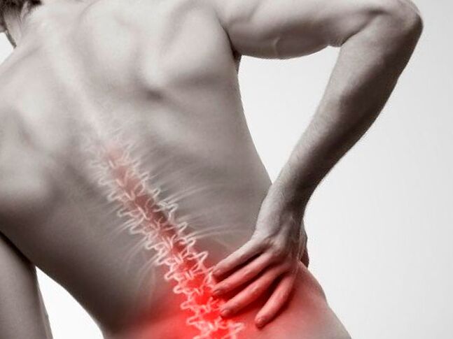 Dolore lombare dovuto all'osteocondrosi