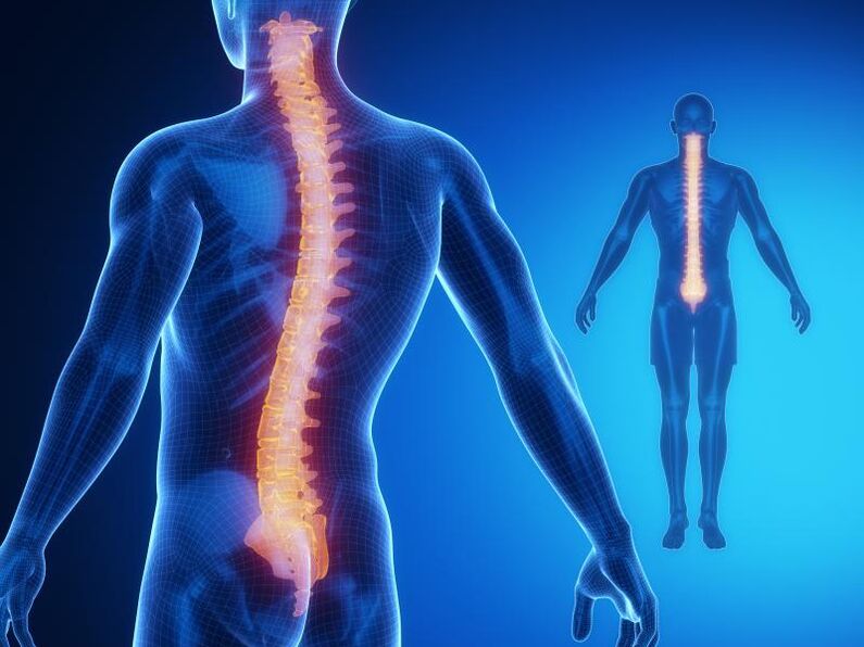Osteocondrosi della colonna vertebrale, che richiede un trattamento complesso