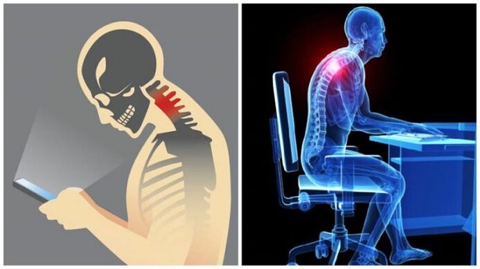 lavoro sedentario e chinarsi come ragioni per lo sviluppo dell'osteocondrosi