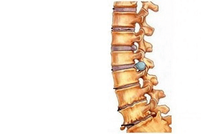 Cambiamenti nella colonna vertebrale nelle diverse fasi dello sviluppo dell'osteocondrosi cervicale