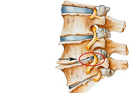 Disco intervertebrale pizzicato nella colonna vertebrale come causa dell'osteocondrosi cervicale