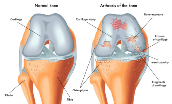 Articolazione normale e influenzata dall'osteoartrosi
