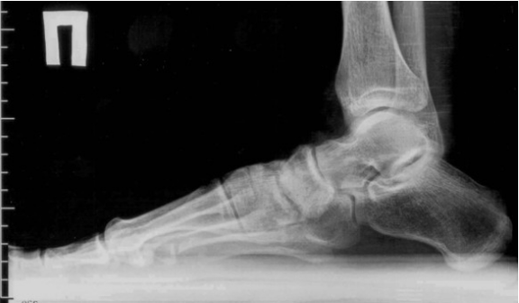 Artrosi delle dita dei piedi e dei piedi